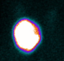 Indications du traitement des hyperthyroïdies par l'iode radioactif Indications du traitement des hyperthyroïdies par l'iode radioactif