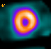 Scintigraphie myocardique