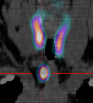 Scintigraphie des Parathyroides