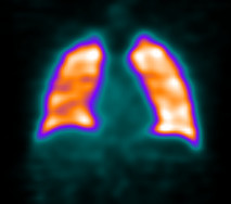 Scintigraphie Pulmonaire