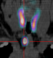 Scintigraphie des Parathyroides Scintigraphie des Parathyroides