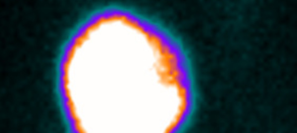 Indications du traitement des hyperthyroïdies par l'iode radioactif