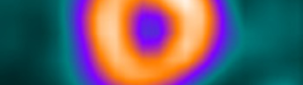 Indications de la scintigraphie myocardique