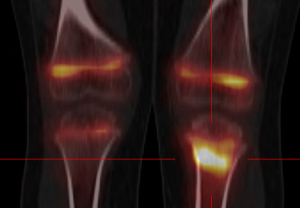 Indications de la scintigraphie osseuse
