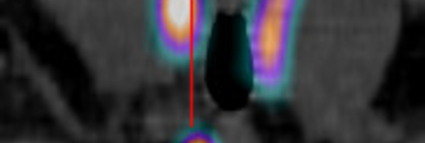 Indications de la scintigraphie parathyroidienne