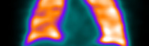 Indications de la scintigraphie pulmonaire