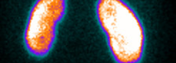 Indications de la scintigraphie renale au DMSA