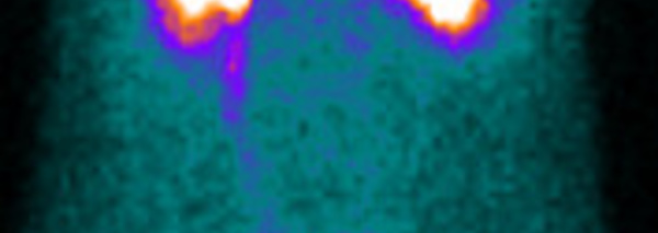 Indications de la scintigraphie renale au DTPA ou au Mag3