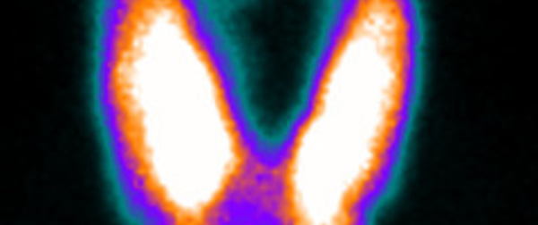 Indications de la scintigraphie thyroidienne