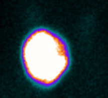 Indications du traitement des hyperthyroïdies par l'iode radioactif Indications du traitement des hyperthyroïdies par l'iode radioactif