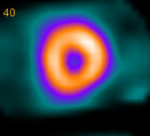 Indications de la scintigraphie myocardique Indications de la scintigraphie myocardique