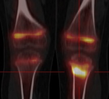 Indications de la scintigraphie osseuse Indications de la scintigraphie osseuse