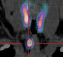 Indications de la scintigraphie parathyroidienne Indications de la scintigraphie parathyroidienne