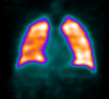 Indications de la scintigraphie pulmonaire Indications de la scintigraphie pulmonaire
