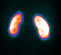 Indications de la scintigraphie renale au DMSA Indications de la scintigraphie renale au DMSA
