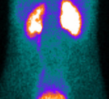 Indications de la scintigraphie renale au DTPA ou au Mag3 Indications de la scintigraphie renale au DTPA ou au Mag3