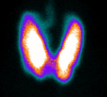 Indications de la scintigraphie thyroidienne Indications de la scintigraphie thyroidienne